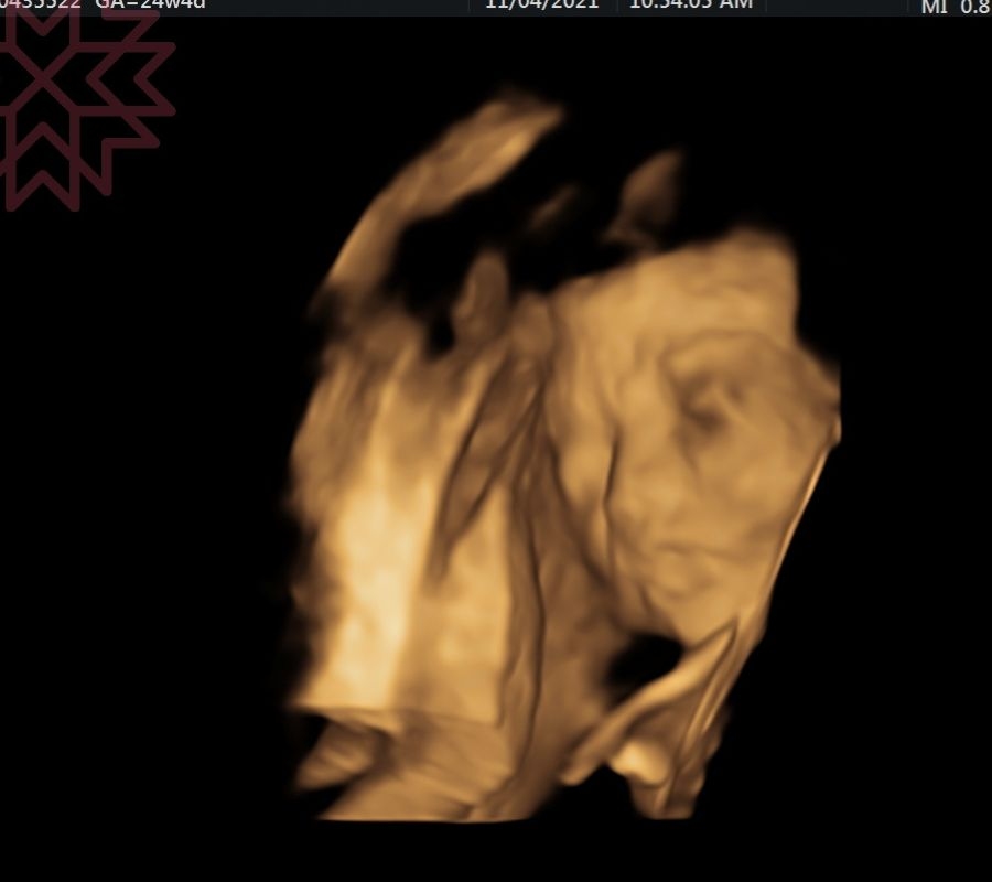 禾馨診所懷孕照胎兒超音波週數